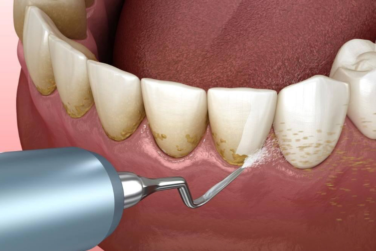 دندان‌پزشکان با انجام اقدامات مداخله‌ای مانند جرم‌گیری و برخی جراحی‌ها می‌توانند بیماری لثه را درمان کنند.